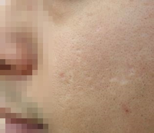강남여드름흉터치료 후 패임이 채워진 상태
