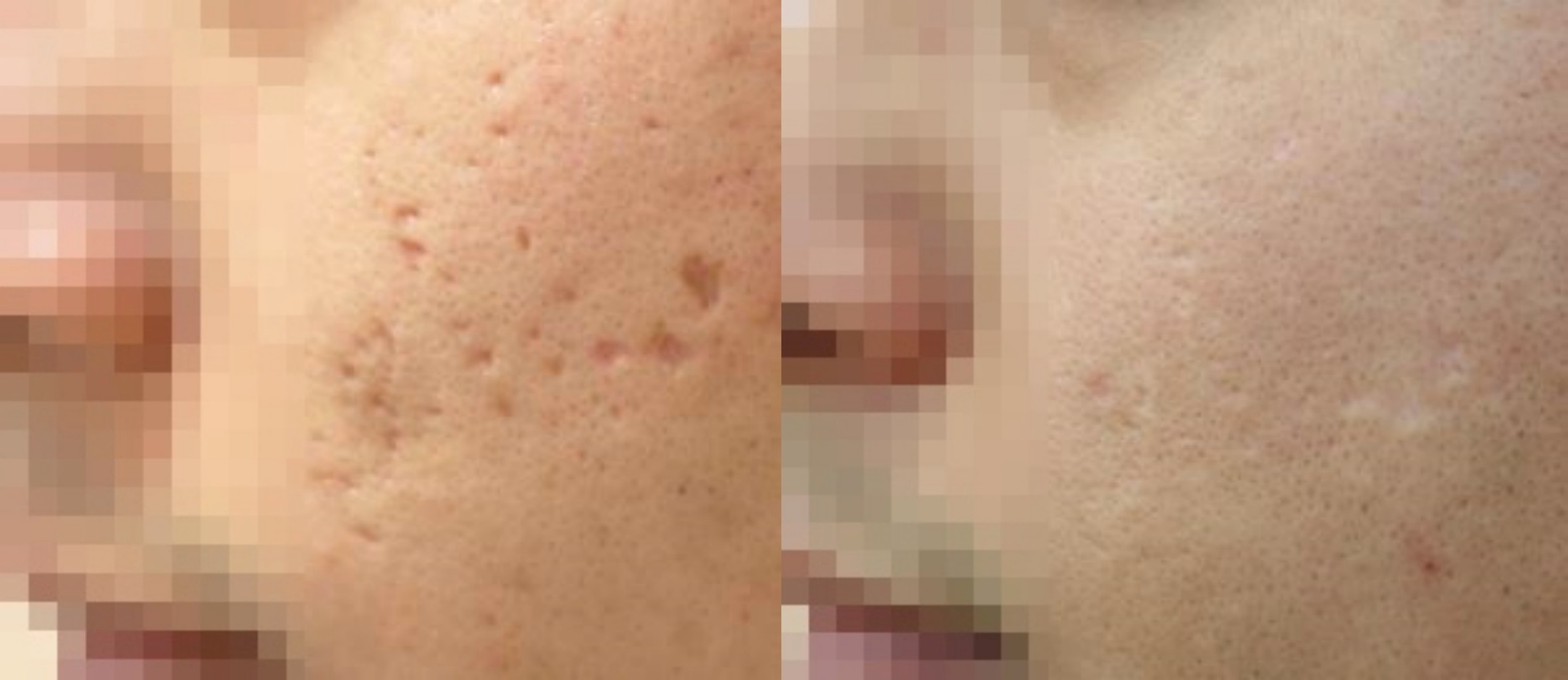 강남여드름흉터치료 전후 큰 변화가 보이는 모습