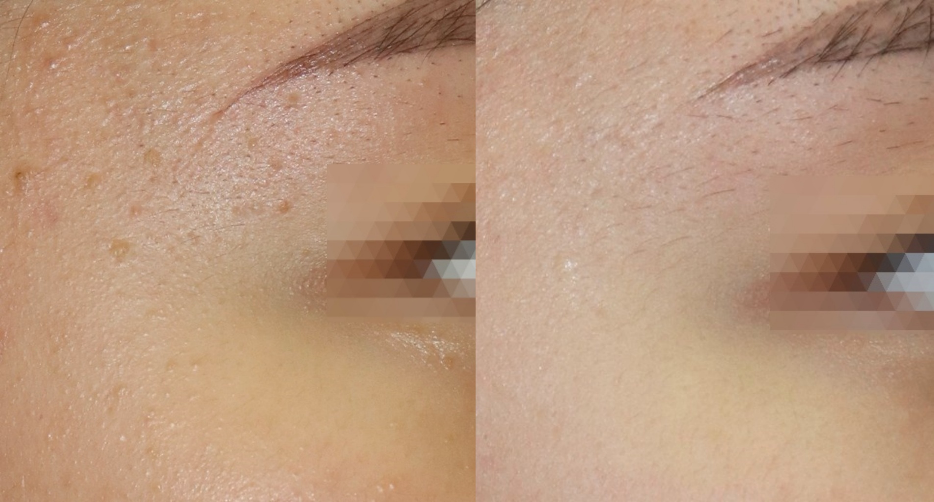 눈가 편평사마귀 치료 전후 비교 사진