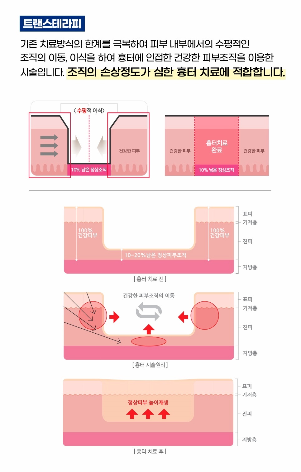 트랜스테라피 시술 원리