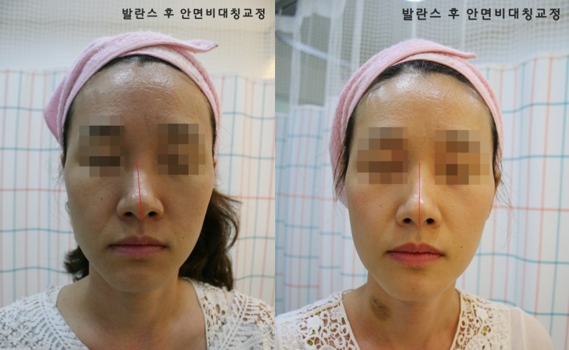 강남 안면비대칭 교정 전 코 턱 교정 전후