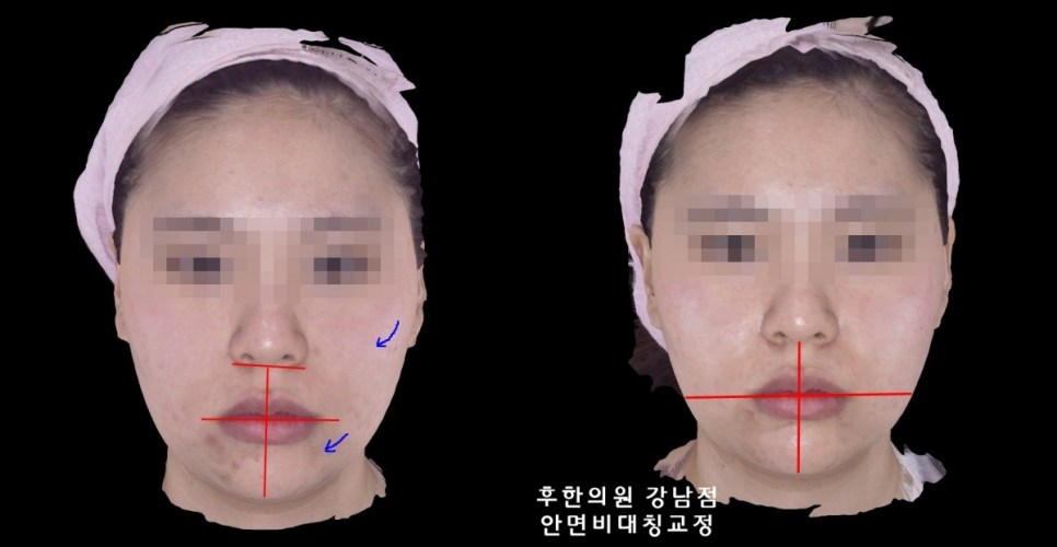 후한의원 강남점 안면비대칭교정 치료 전후 정렬 사진