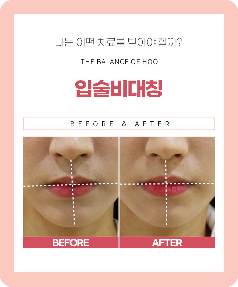 입술비대칭 치료 전후 비교 사진, 신사역 안면비대칭한의원