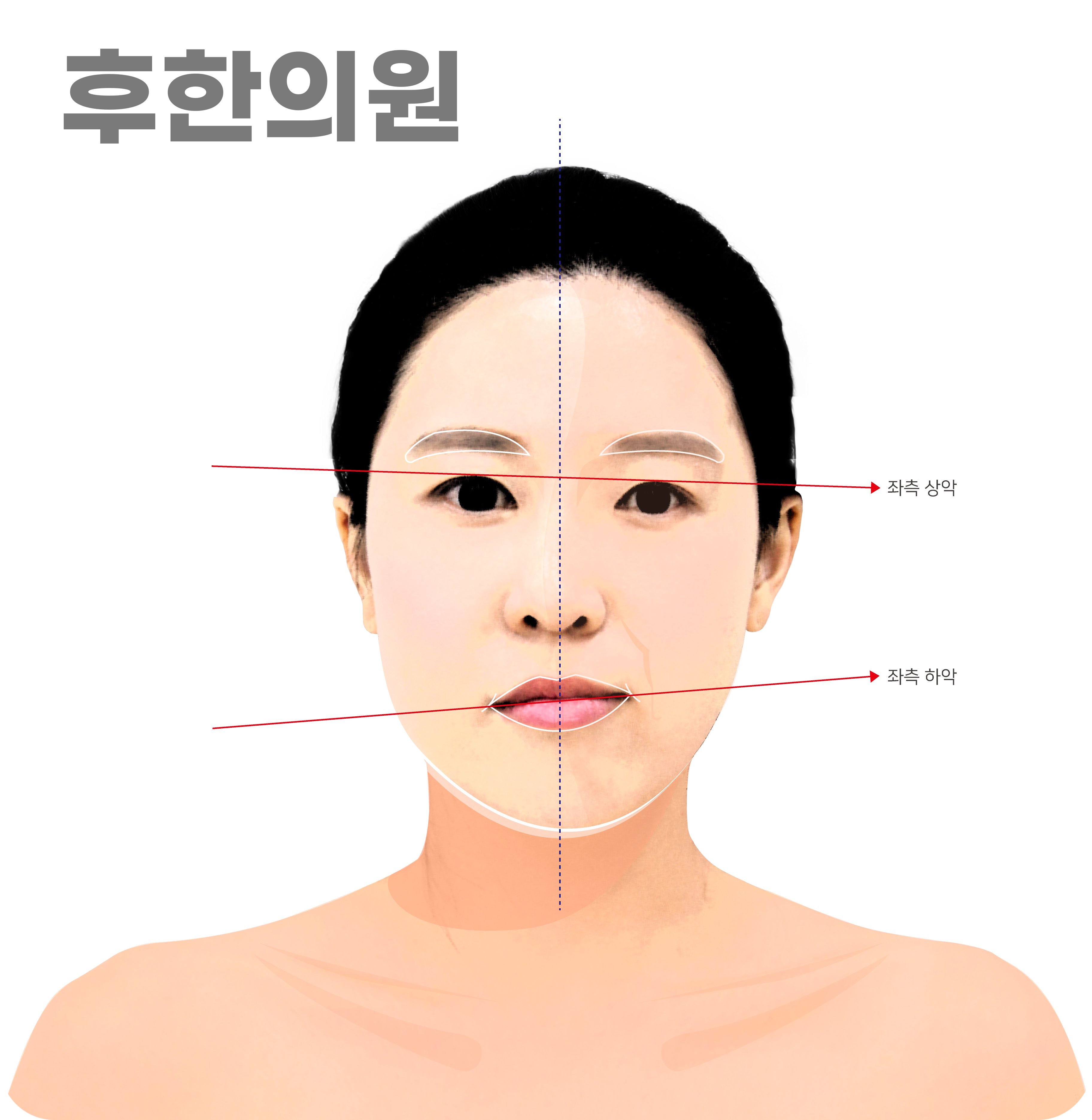 안면비대칭 타입2 상악 하악 동반 회전 진단 이미지, 신사역 안면비대칭한의원