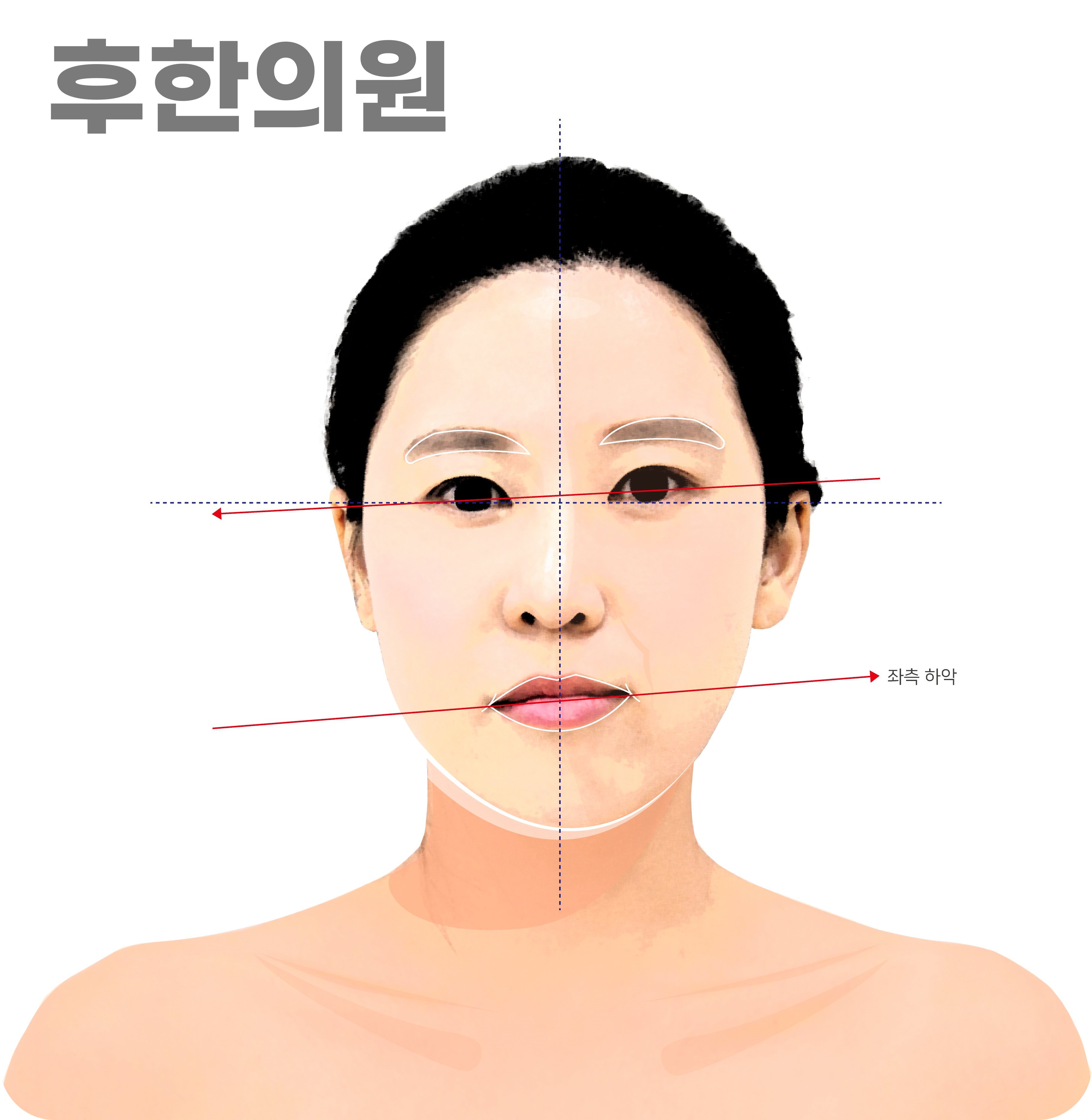 안면비대칭 타입3 상악 하악 반대 방향 회전 진단 이미지, 신사역 안면비대칭한의원