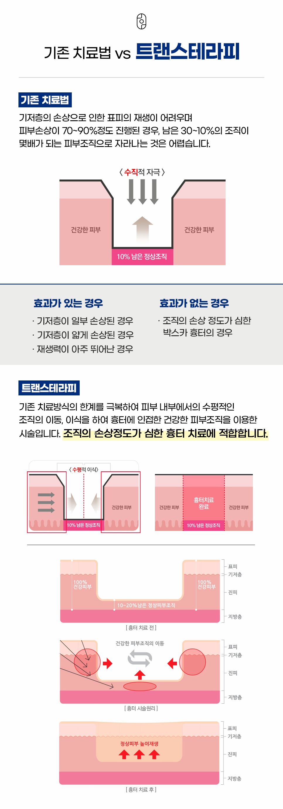 기존 흉터 치료법과 트랜스테라피 원리 비교, 수직적 자극과 수평적 이식 방식 차이