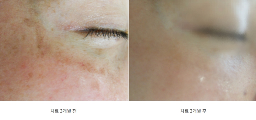 기미 치료 3개월 치료 전후 비교 사진
