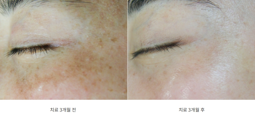 눈가 기미 3개월 치료 후 옅어진 모습