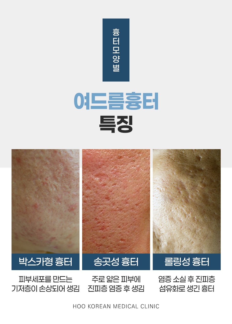 	여드름흉터 박스카형 송곳성 롤링성 모양별 특징 비교