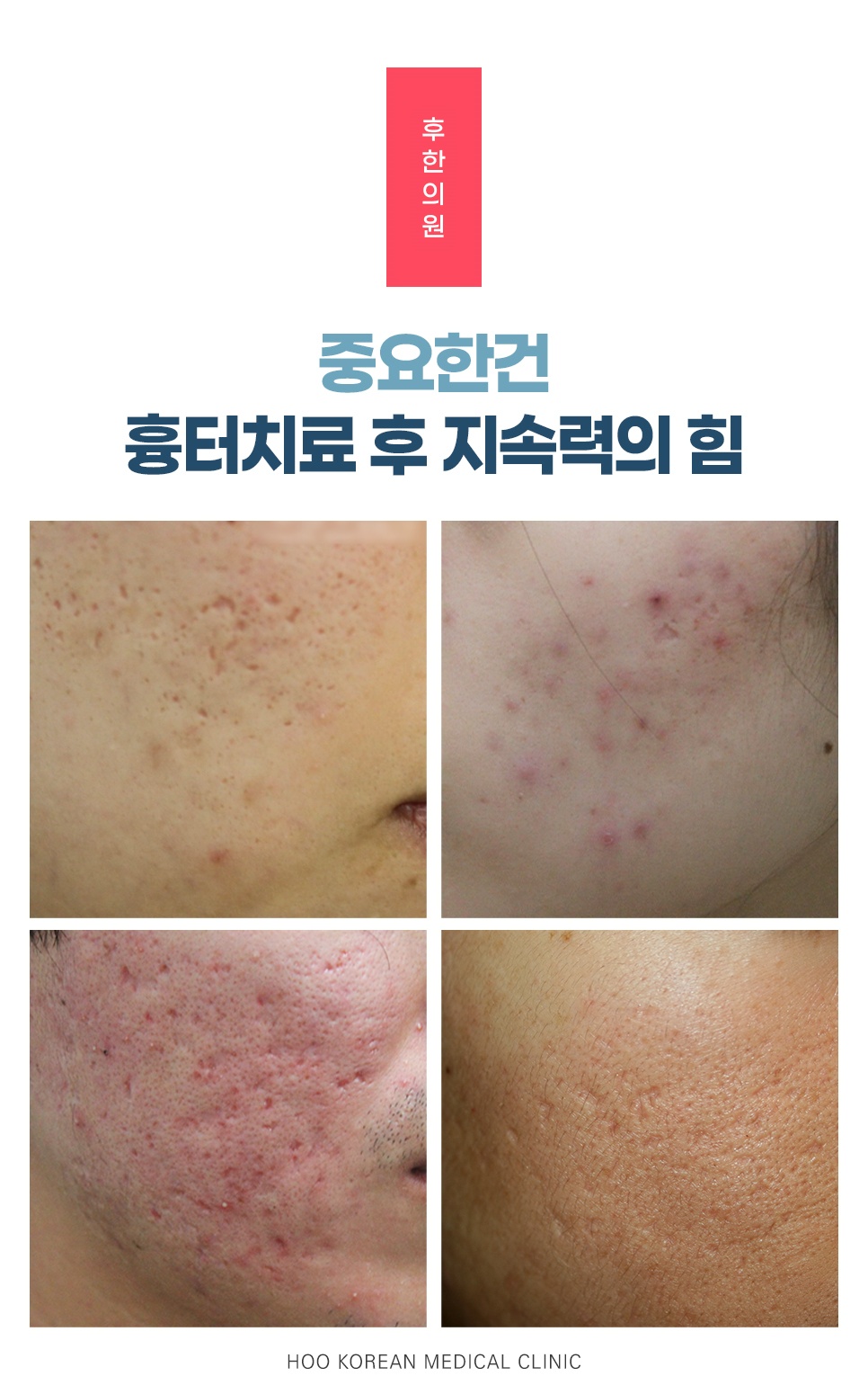 패인여드름흉터 치료 후 중요한 건 지속력의 힘