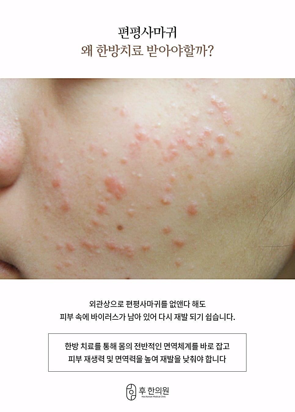 편평사마귀 한방치료가 필요한 이유 안내