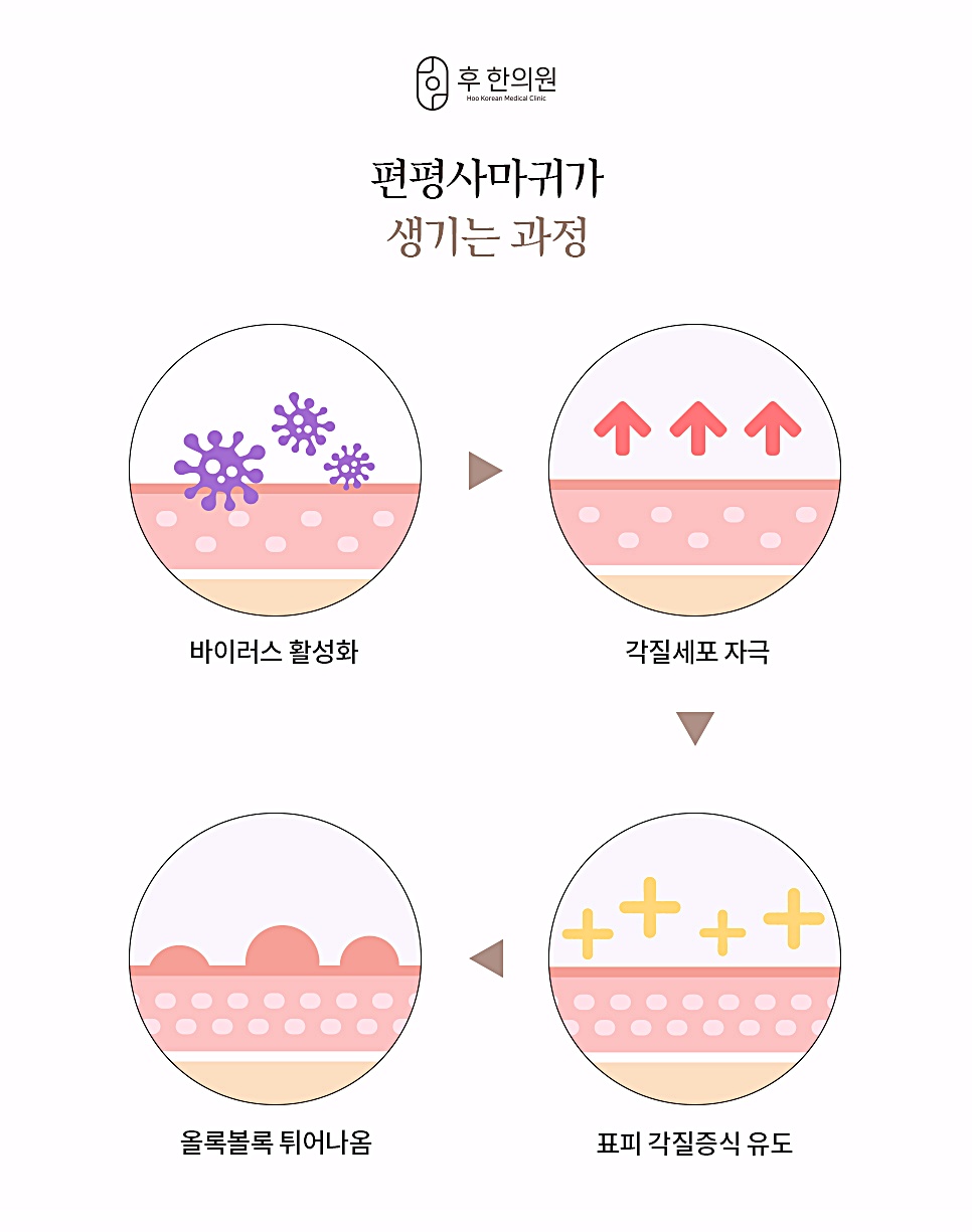 압구정 편평사마귀가 생기는 과정 4단계 다이어그램, 바이러스 활성화-각질세포 자극-표피 각질증식 유도-올록볼록 튀어나옴