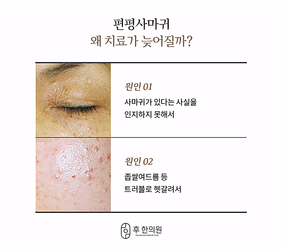압구정 편평사마귀 치료가 늦어지는 이유