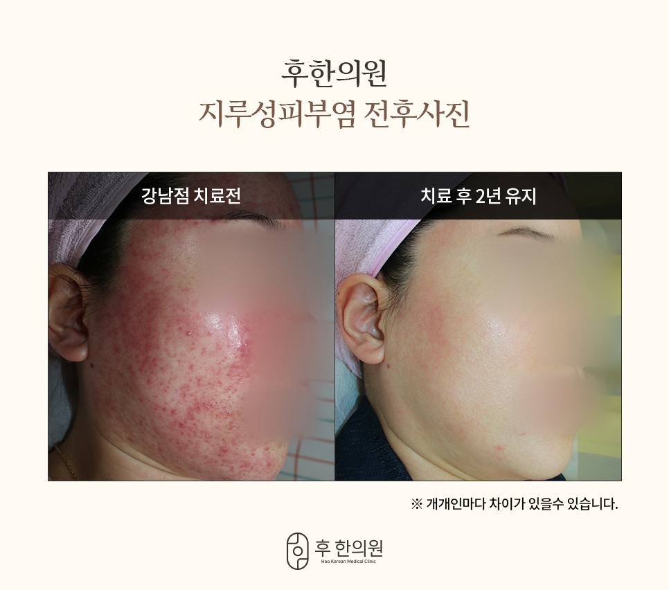후한의원 지루성피부염 강남점 치료 전후 얼굴 측면 비교 사진