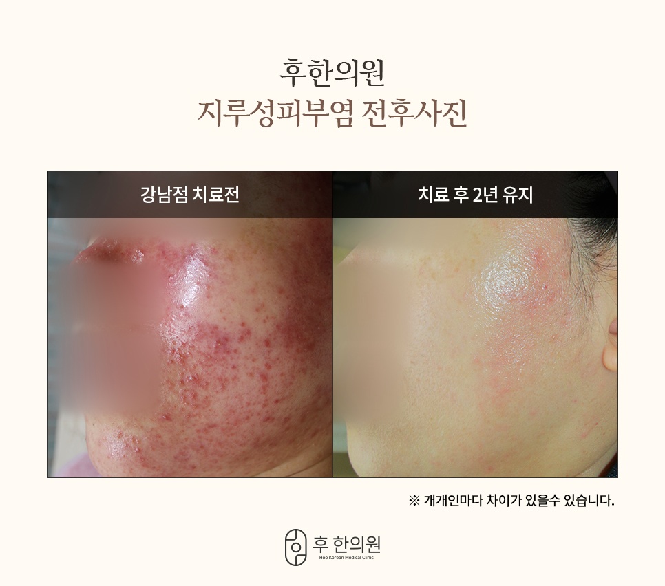 후한의원 지루성피부염 강남점 치료 전후 볼 비교 사진