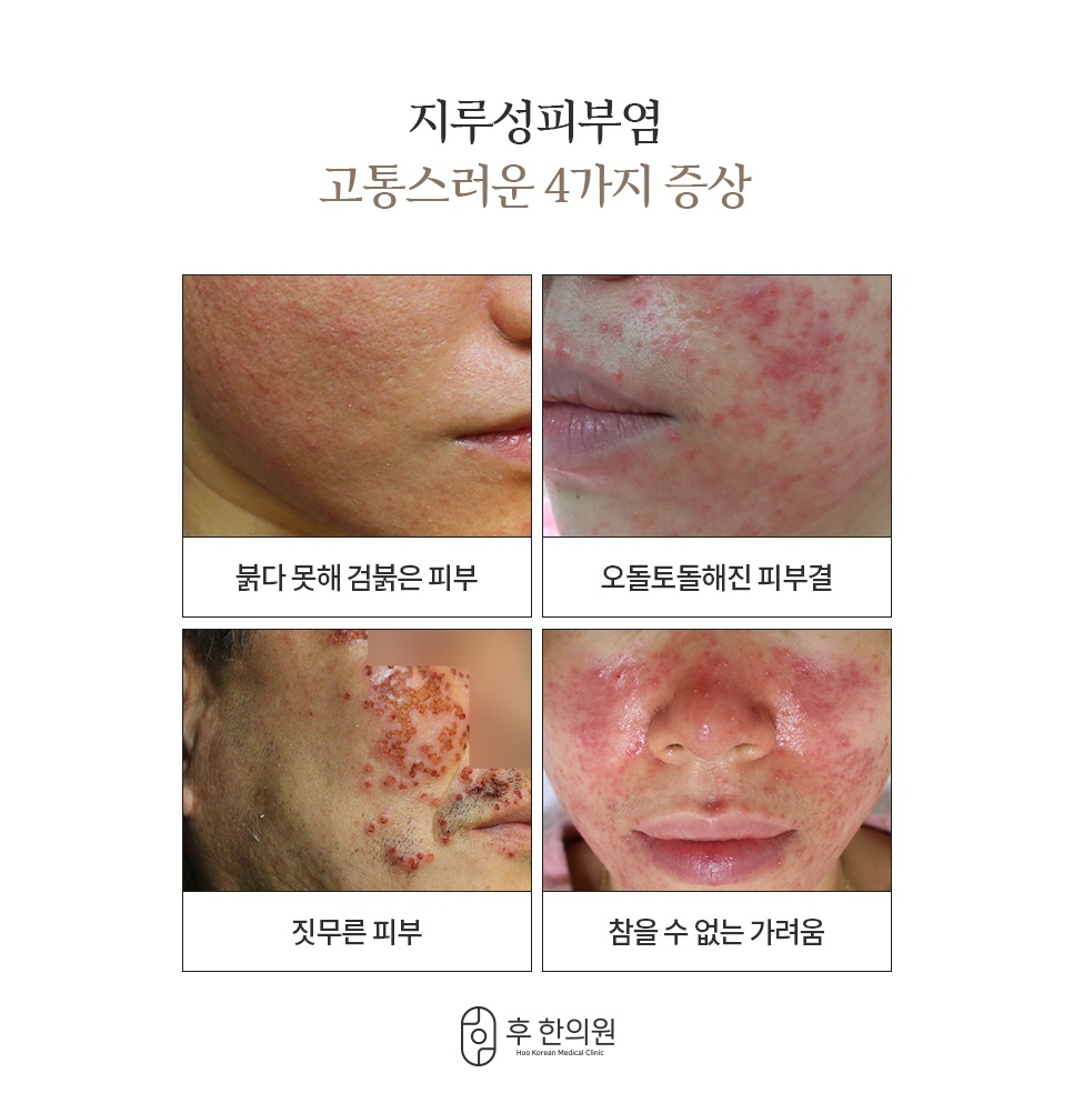지루성피부염 4가지 증상