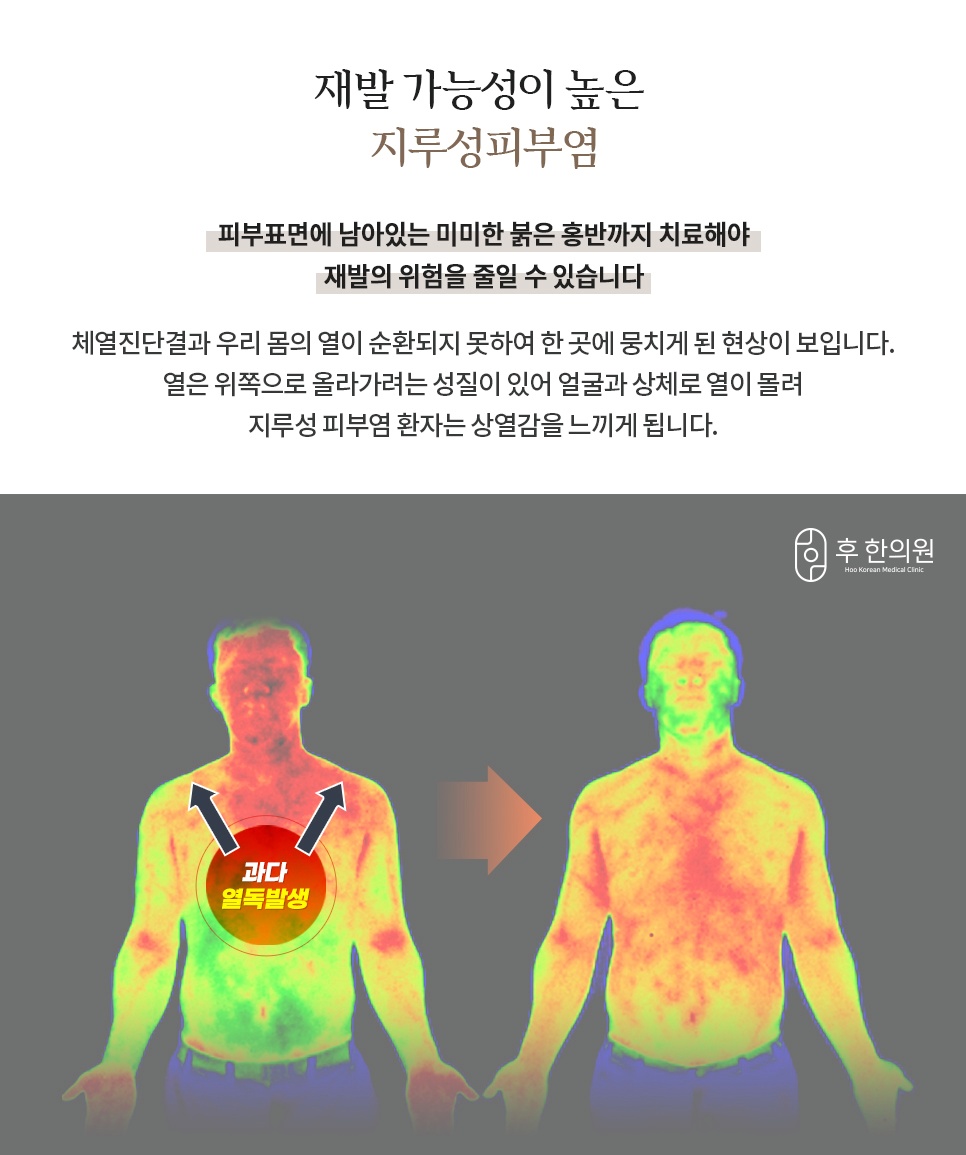 지루성피부염 체열진단 열독 발생 부위 비교