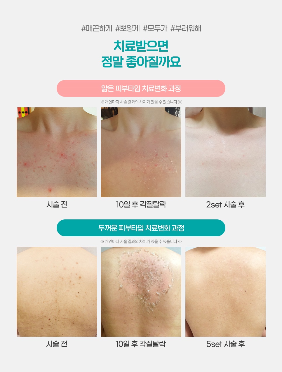 얇은 피부와 두꺼운 피부 타입별 등드름 치료 변화 과정 비교 사진