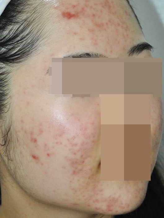 여드름 치료 전 이마와 볼에 붉은 염증이 있는 얼굴 피부