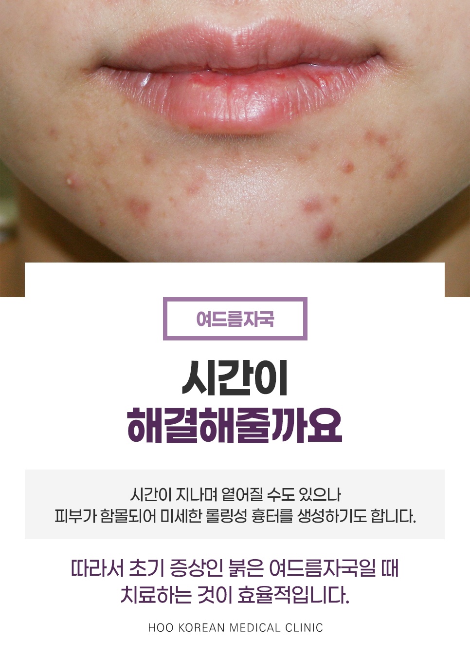 붉은 여드름 자국 방치 시 롤링성 흉터 진행 가능성 및 초기 치료 중요성