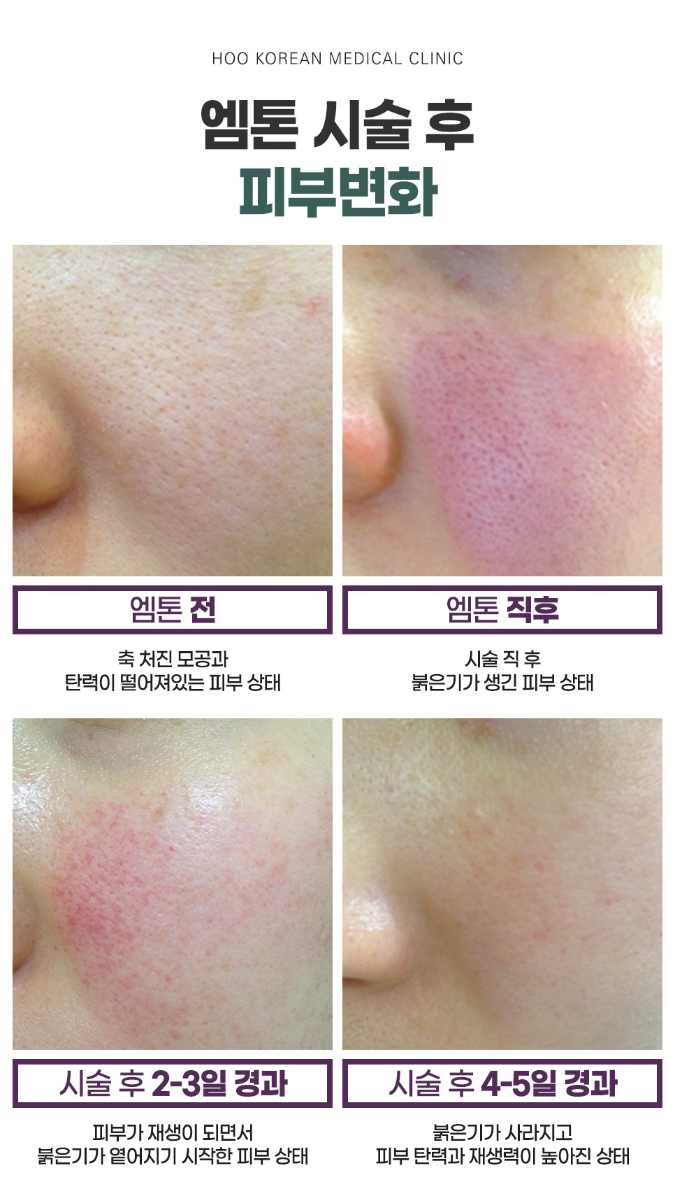 엠톤 시술 후 경과별(직후, 2~3일, 4~5일) 피부 재생 및 붉은기 변화 과정