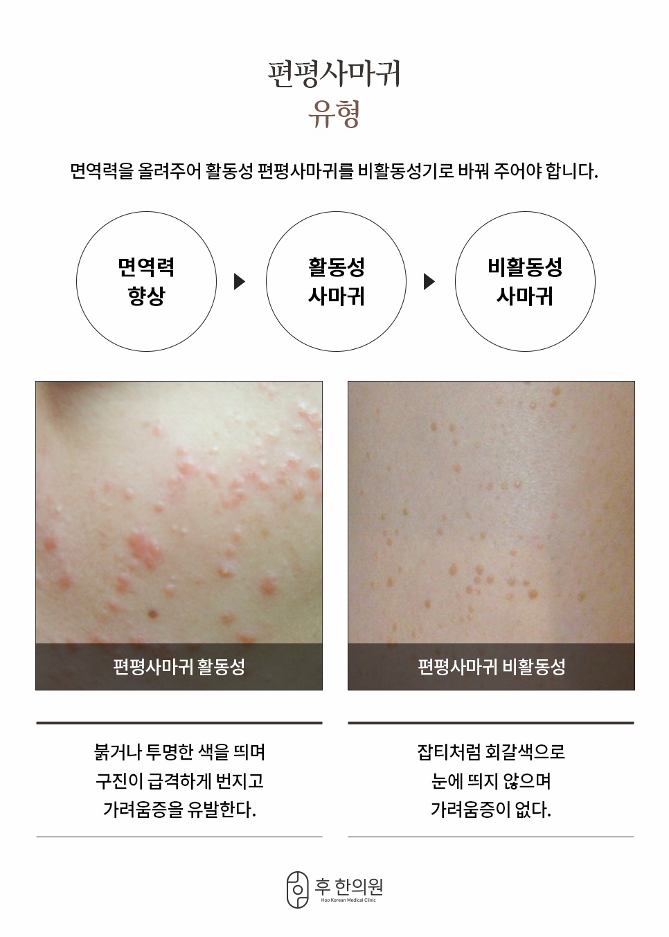 편평사마귀 활동성 비활동성 유형 및 면역력 향상 과정 안내