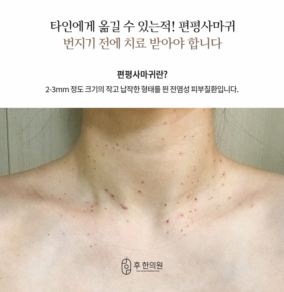 강남편평사마귀한의원 목 가슴 부위 편평사마귀 증상
