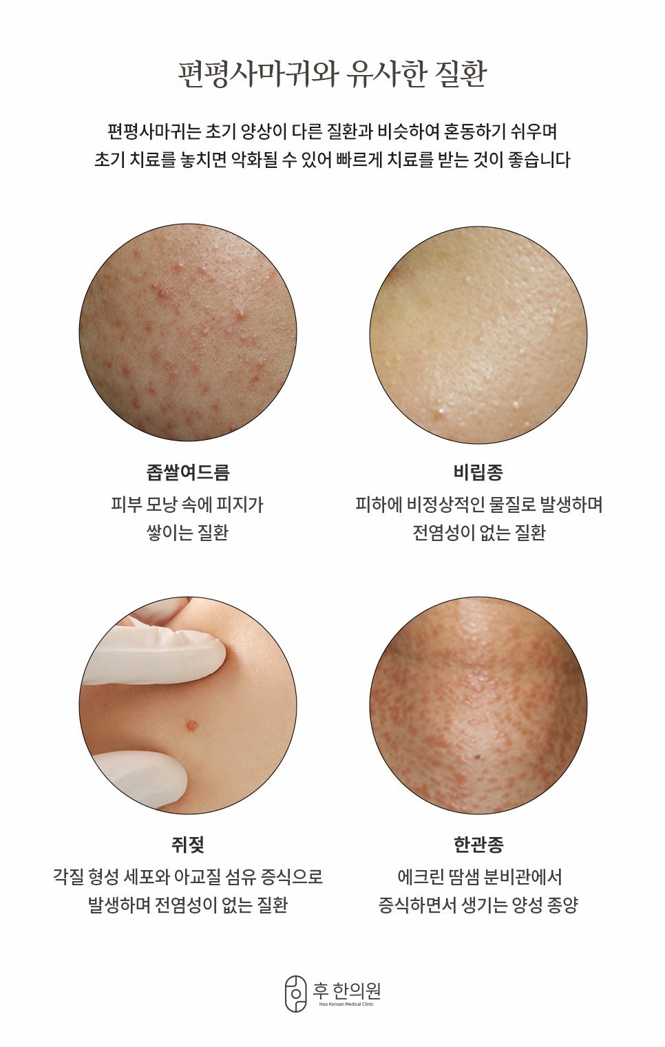 편평사마귀와 유사한 질환 좁쌀여드름 비립종 쥐젖 한관종 비교