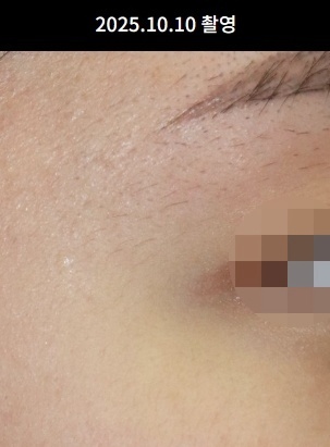 강남편평사마귀 치료 후 눈가 깨끗하게 회복된 피부 상태
