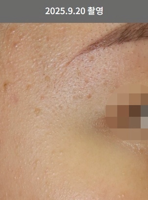 강남편평사마귀 치료 전 눈가 전염성 사마귀 피부 상태