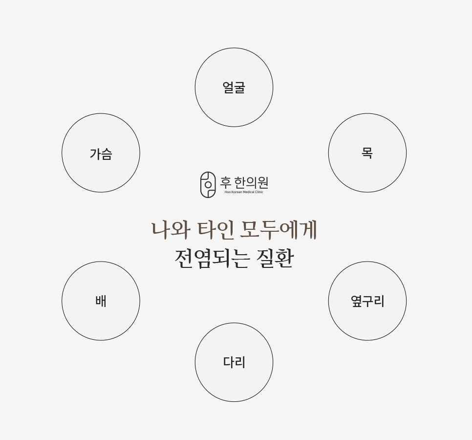 편평사마귀 전염 부위 얼굴 목 가슴 배 옆구리 다리 안내