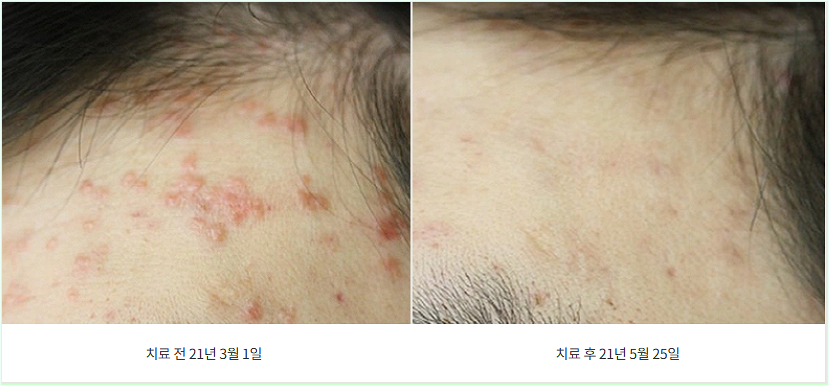 신사역편평사마귀제거 전후 참고 사례
