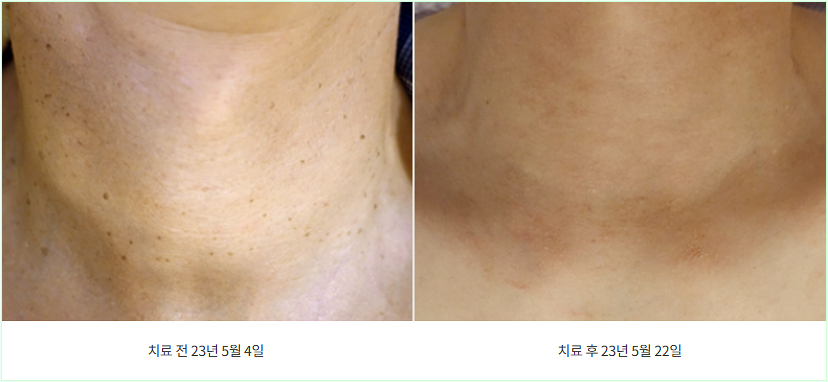 목 부분 편평사마귀 제거 전후