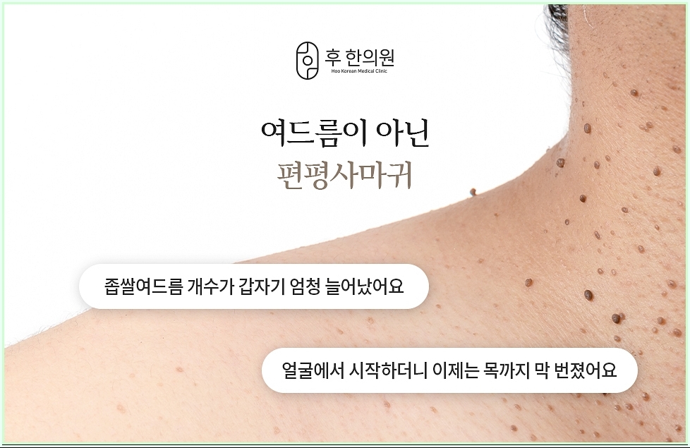 편평사마귀의 정의에 대한 이미지