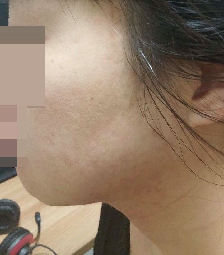 여드름 치료 후 피부 상태 사례 사진