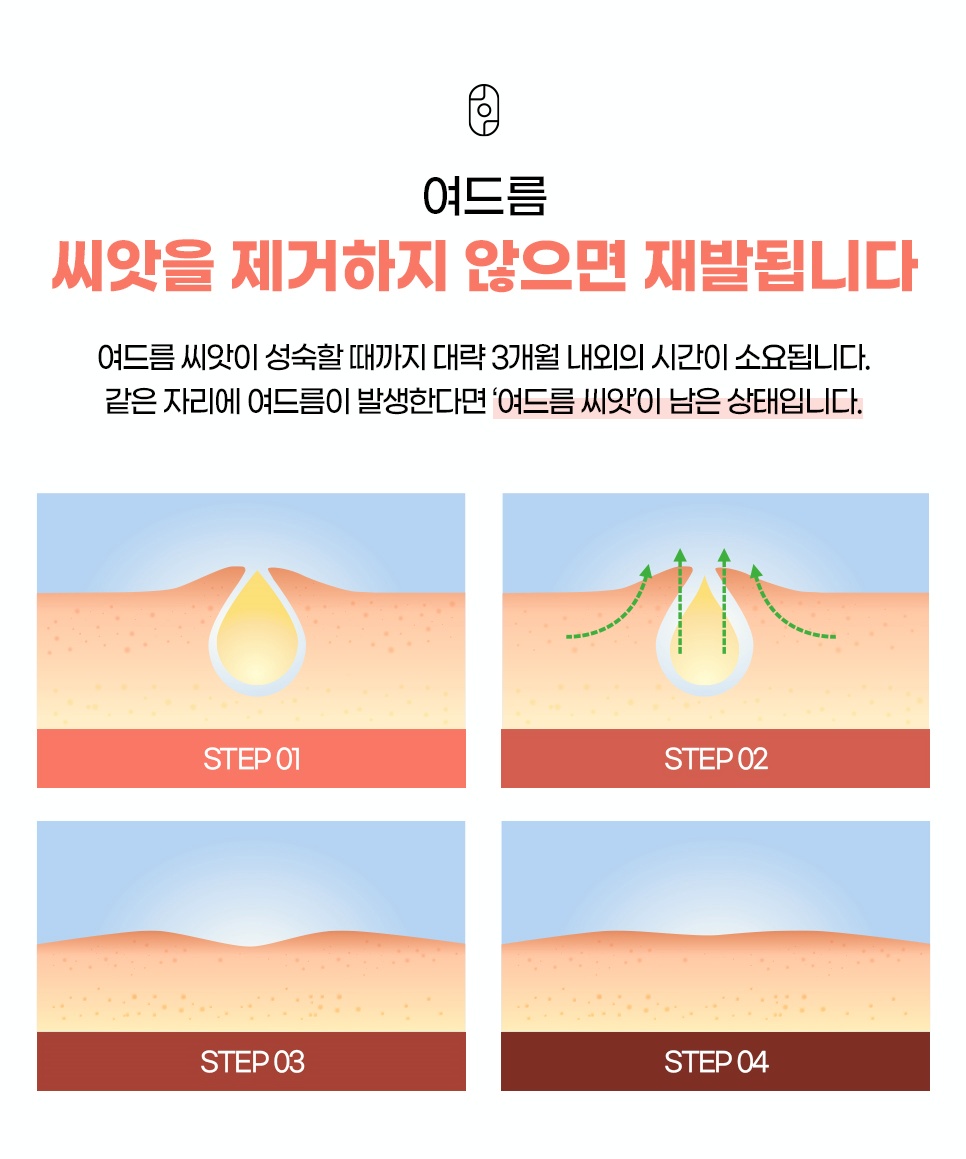여드름 씨앗 제거의 중요성 및 성숙 기간(약 3개월 내외) 안내