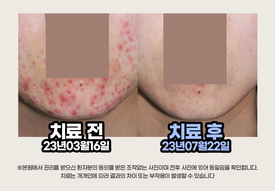 여드름 치료 전/후 비교 사례 2 (23년 3월 16일 ~ 23년 7월 22일)