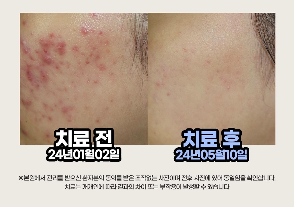 여드름 치료 전/후 비교 사례 1 (24년 1월 2일 ~ 24년 5월 10일)