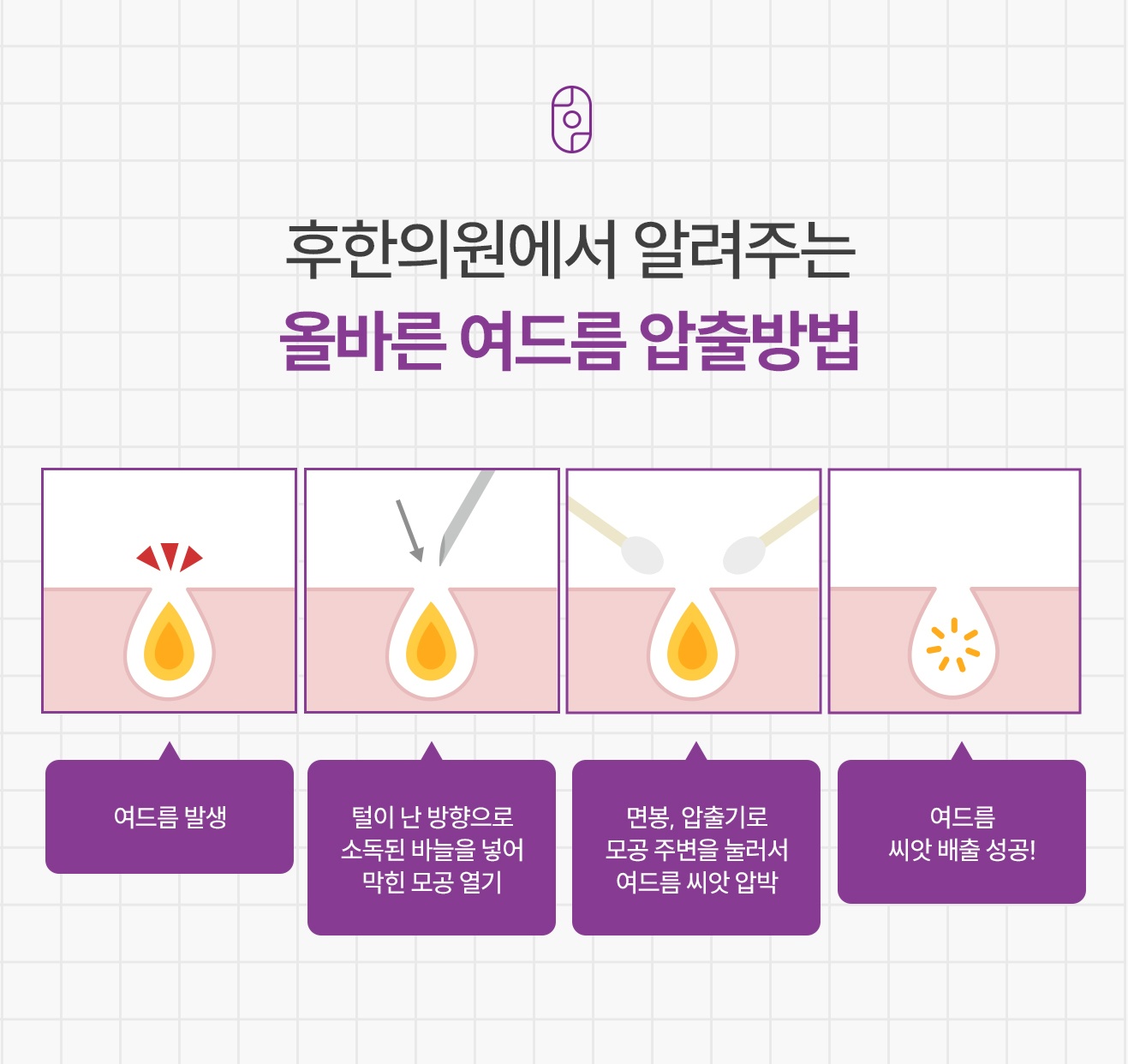 후한의원 올바른 여드름 압출 순서 4단계