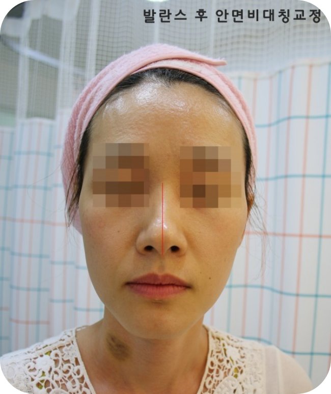 콧대 중심선이 기울어진 안면비대칭 치료 후 정면 사진