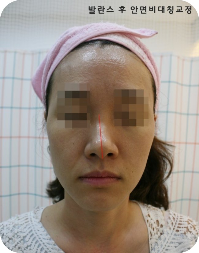 콧대 중심선이 기울어진 안면비대칭 치료 전 정면 사진