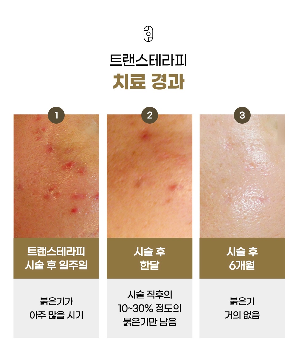 시술 일주일·한 달·6개월 시기별 피부 붉은기 변화 과정