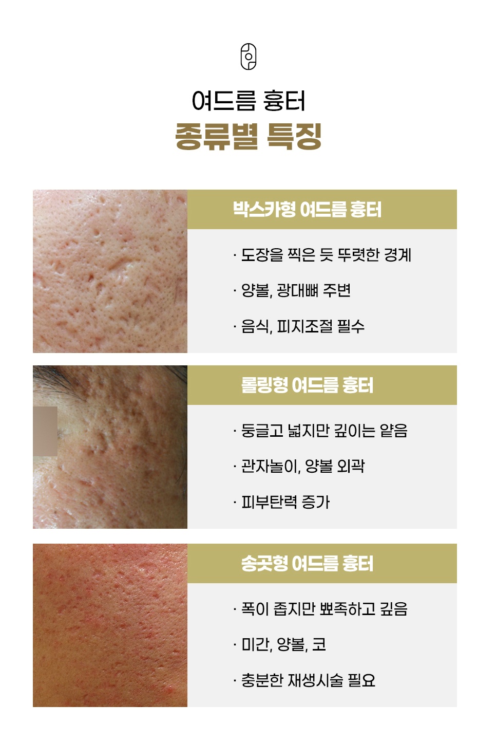 박스카형·롤링형·송곳형 여드름 흉터 종류별 특징 비교