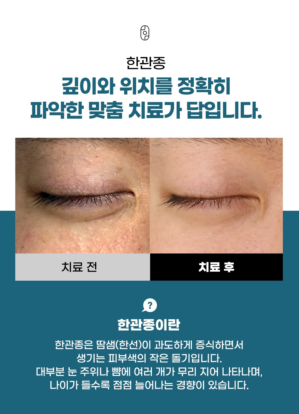 눈가에 생긴 작은 돌기, 한관종이란?