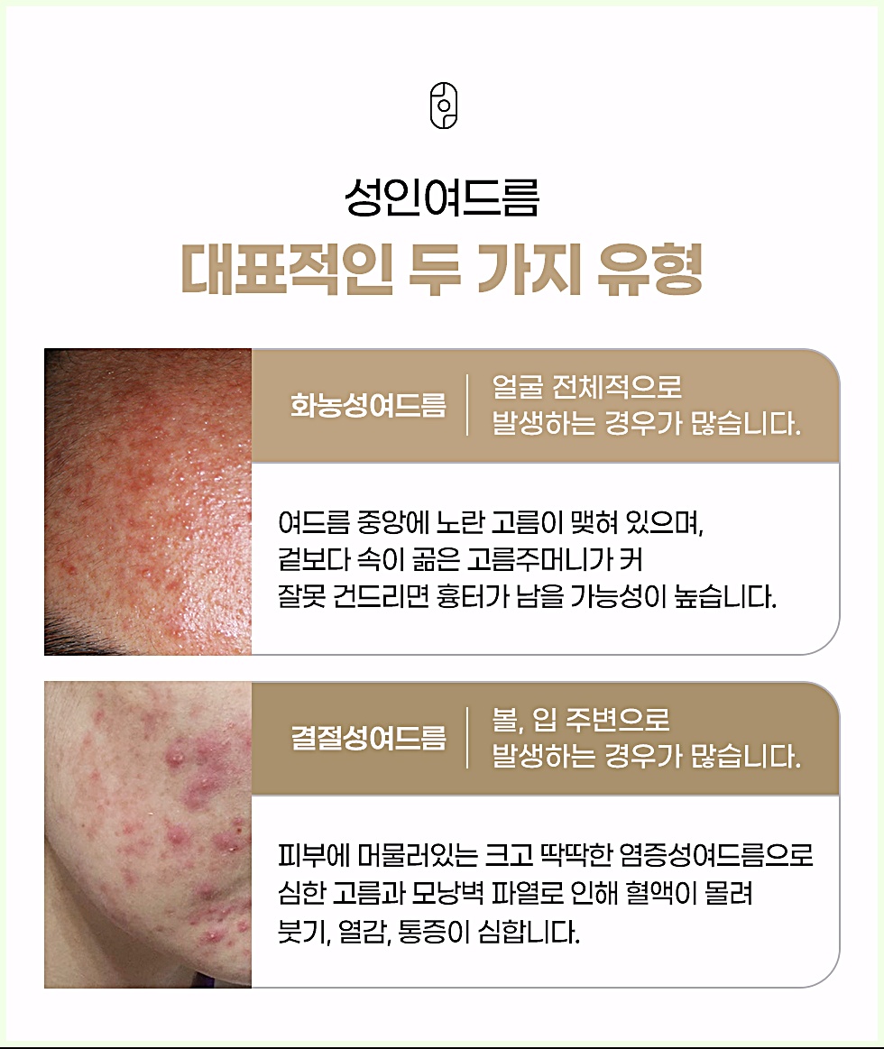 화농성여드름과 결절성여드름의 차이를 설명하는 성인여드름 두 가지 유형