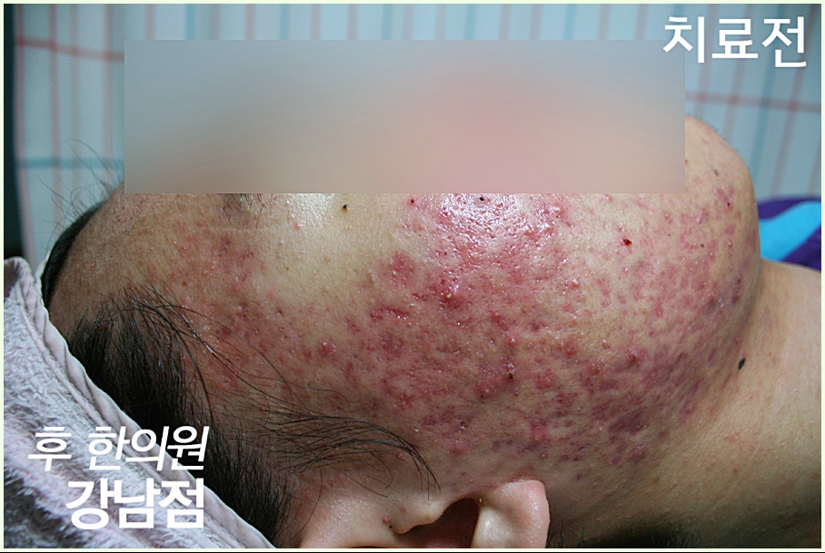 신사여드름피부과 관자놀이 부위 화농성여드름 치료 전 사진