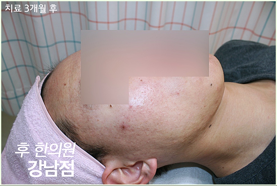 신사여드름피부과 치료 3개월 후 피부 변화를 보여주는 치료 후 사진