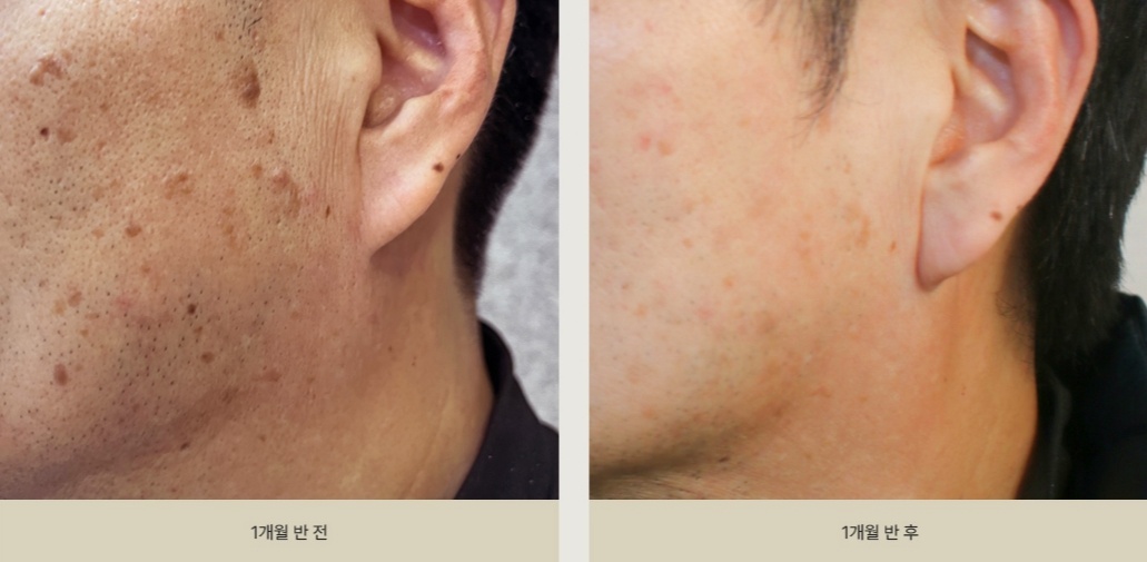 1개월 반 간격으로 본 턱선 지루각화증 치료 전후 변화