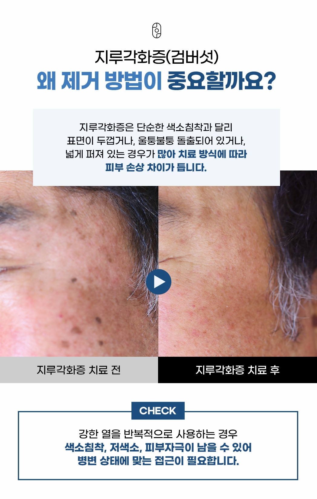 제거 방식에 따라 피부 손상 차이가 나는 지루각화증 치료 전후 이마 비교