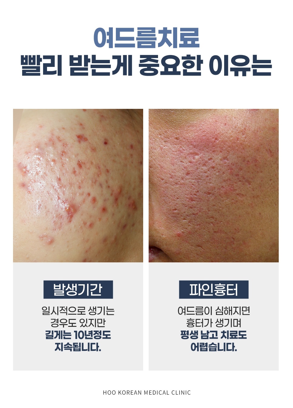 여드름 피부 방치 시 파인 흉터 발생 위험과 조기 치료 중요성